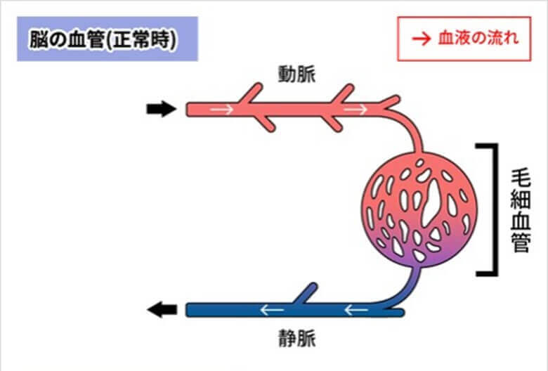 脳動静脈奇形