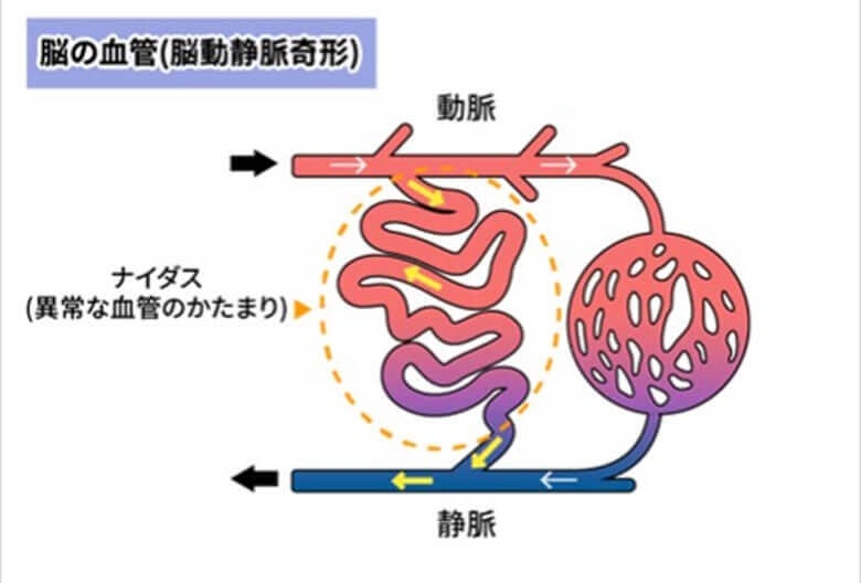 脳動静脈奇形