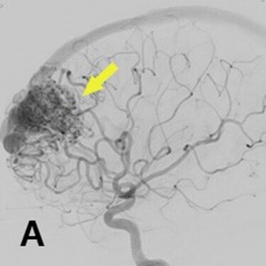 脳動静脈奇形
