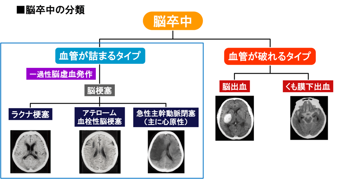 脳卒中