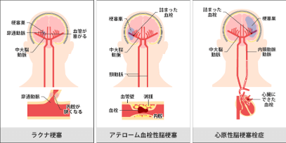 脳卒中