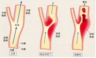 脳卒中